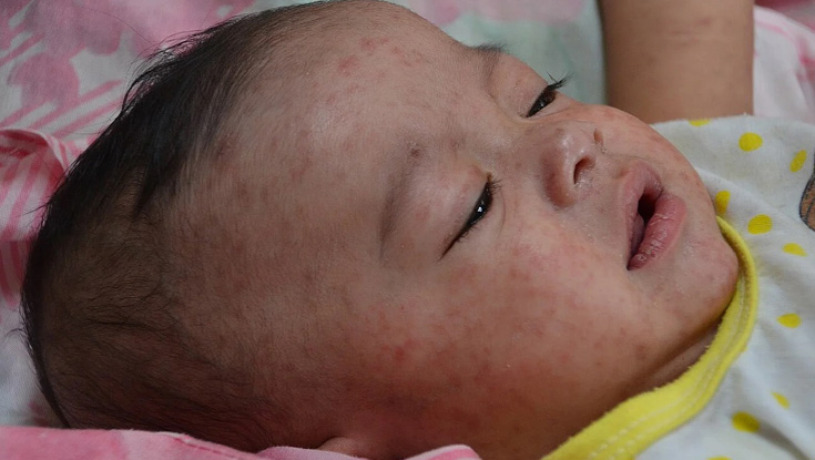 শিশুর হাম হলে করণীয় 