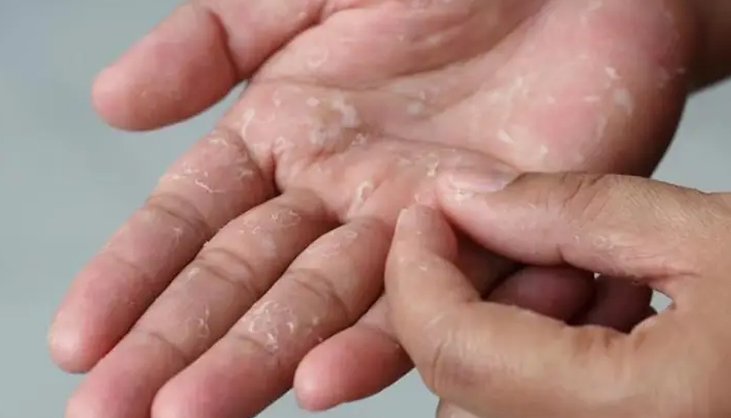 শীতকালে যে কারণে হাত-পায়ের চামড়া ঝরে পড়ে