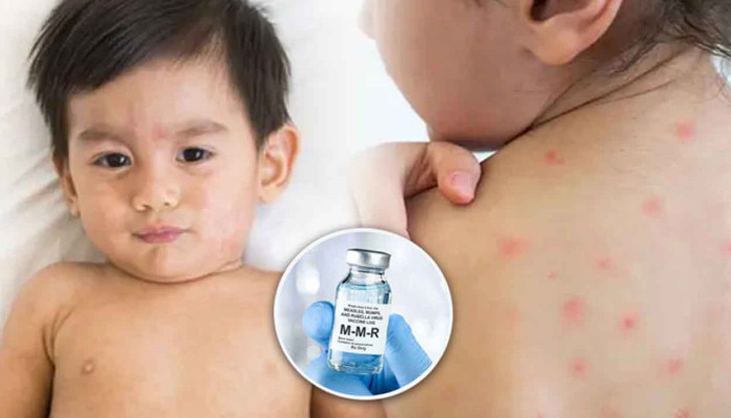 হাম উপসর্গে আরও ৫ শিশুর মৃত্যু