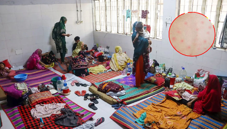 কুমিল্লায় হামে আক্রান্ত ৩ শিশুর মৃত্যু