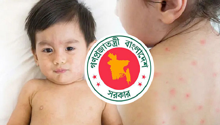 হাম উপসর্গে আরও ২ শিশুর মৃত্যু