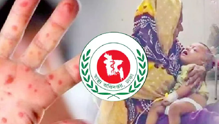 হাম উপসর্গে ৯ জনের মৃত্যু