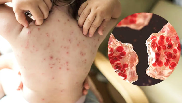 হাম উপসর্গে আরও ৮ জনের মৃত্যু