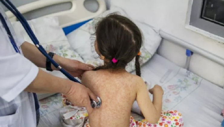 হামের চিকিৎসায় শয্যা বাড়ানোর নির্দেশ