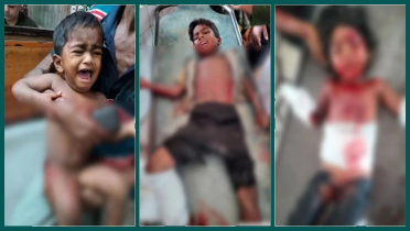 কুড়িয়ে পাওয়া বোমা বিস্ফোরণে একই পরিবারের ৩ শিশু আহত