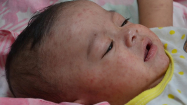 শিশুর হাম হলে করণীয় 