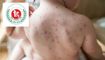 হামে আরও ১০ শিশুর মৃত্যু