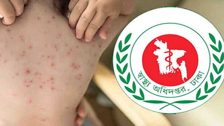 হাম উপসর্গে আরও ৬ শিশুর মৃত্যু