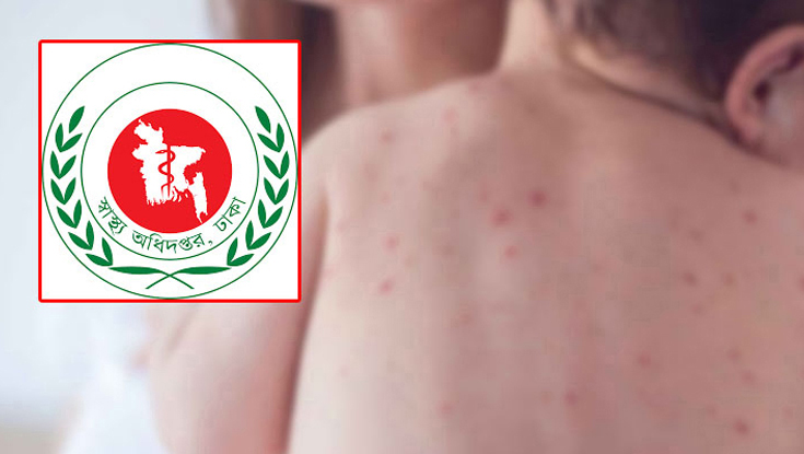 হাম উপসর্গ নিয়ে আরও ৩ শিশুর মৃত্যু