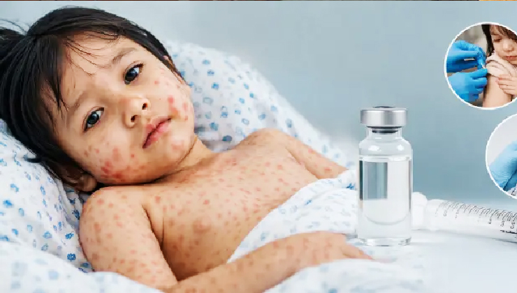 টিকা পায়নি হাম আক্রান্ত ৭৪ শতাংশ শিশু