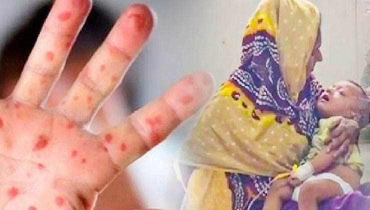 হাম উপসর্গে ২৪ ঘণ্টায় আরও ৯ জনের মৃত্যু