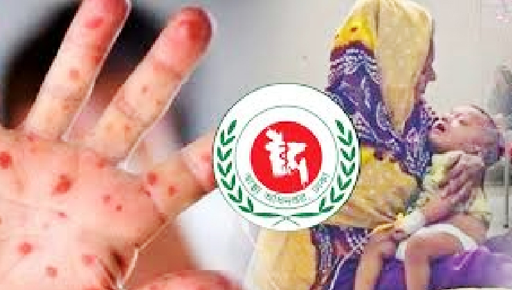 হাম উপসর্গে ২৪ ঘন্টায় ১৭ জনের মৃত্যু
