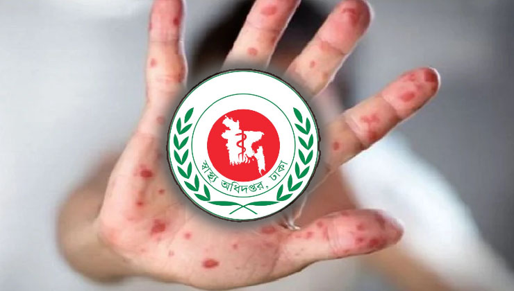 ২৪ ঘণ্টায় হামে ৪ শিশুর মৃত্যু, নতুন রোগী ১৫৯ 
