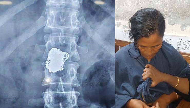 রোগী সেজে সোনার চেইন চুরি, এক্সরে করে শনাক্ত