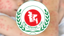 হাম উপসর্গে আরও ২ শিশুর মৃত্যু