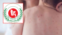 হাম উপসর্গ নিয়ে আরও ৩ শিশুর মৃত্যু