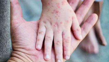 একদিনে হাম উপসর্গে আরও ১২ জনের মৃত্যু