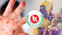 হাম উপসর্গে ২৪ ঘন্টায় ১৭ জনের মৃত্যু