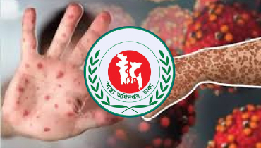 হামের উপসর্গে আরও ৫ শিশুর মৃত্যু