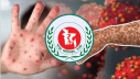 হামের উপসর্গে আরও ৫ শিশুর মৃত্যু হামের উপসর্গে আরও ৫ শিশুর মৃত্যু