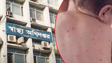 হাম উপসর্গে আরও ৬ শিশুর মৃত্যু