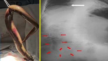 পায়ুপথে জেলের পেটে বাইম মাছ, অতপর... পায়ুপথে জেলের পেটে বাইম মাছ, অতপর...